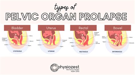 prolapsus gay|Stichwort: Prolaps